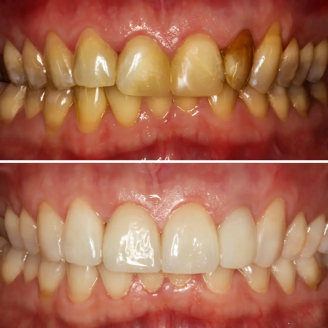 Anterior Crowns & Discoloration Correction - Before and After clinical results at Specialist Dental Clinic Guntur