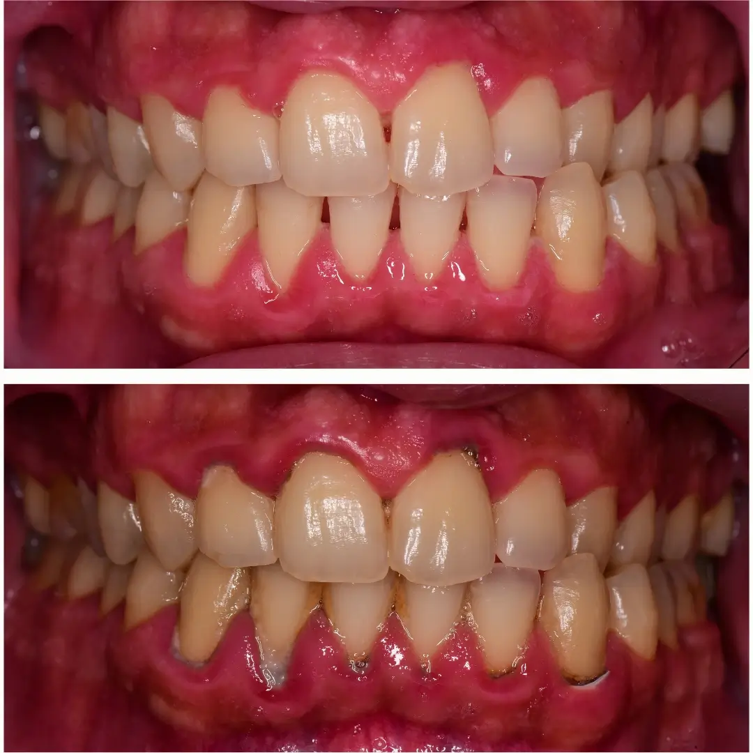 Severe Tartar Removal & Gingival Healing - Before and After clinical results at Specialist Dental Clinic Guntur