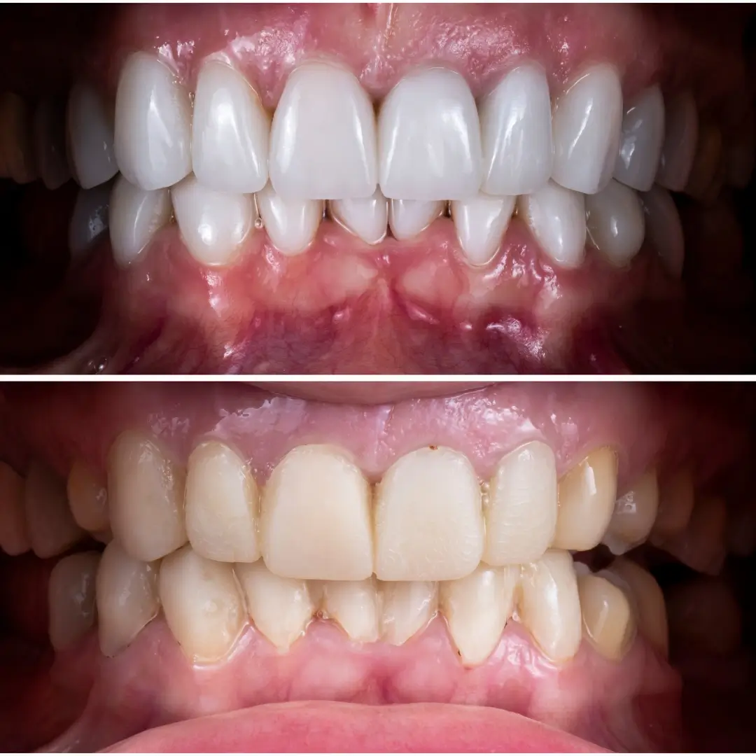 Composite Restorations & Enamel Whitening - Before and After clinical results at Specialist Dental Clinic Guntur