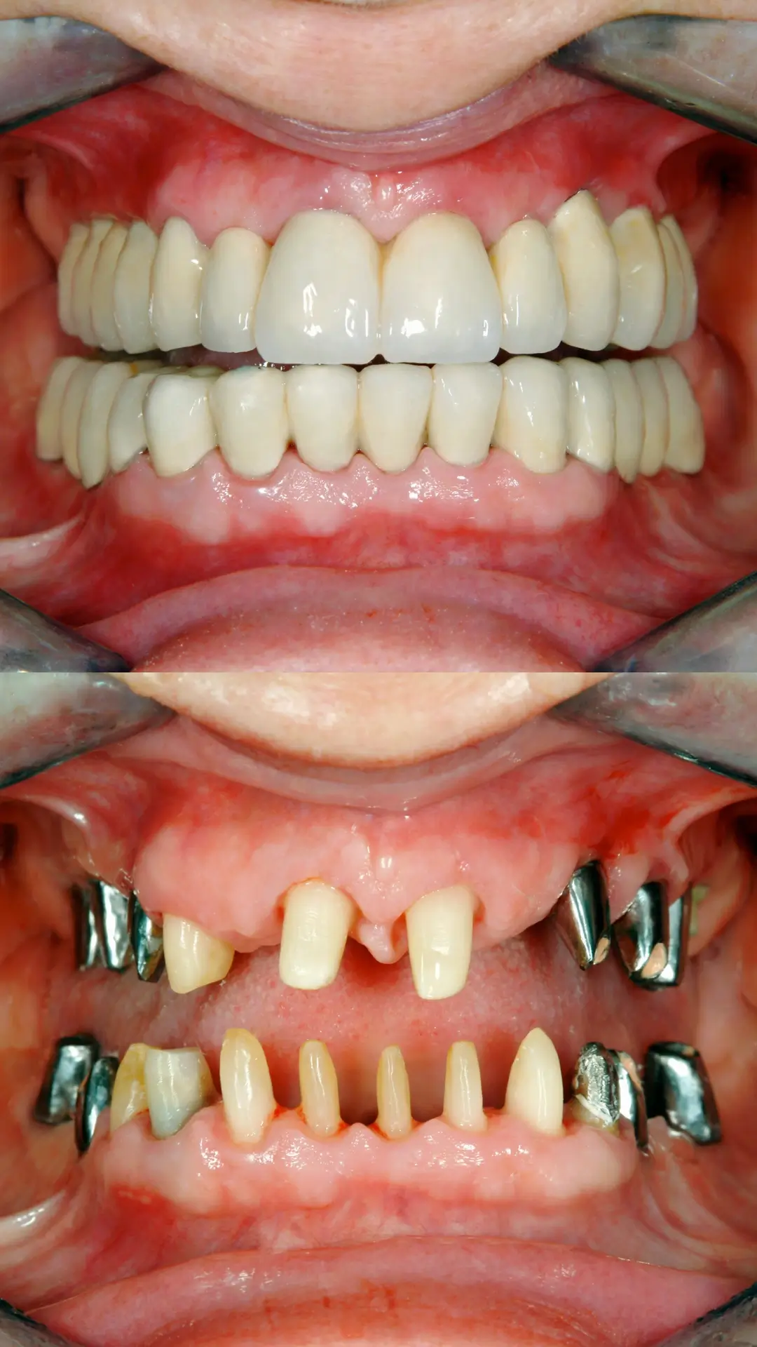 Full Mouth Reconstruction & Rehabilitation - Before and After clinical results at Specialist Dental Clinic Guntur