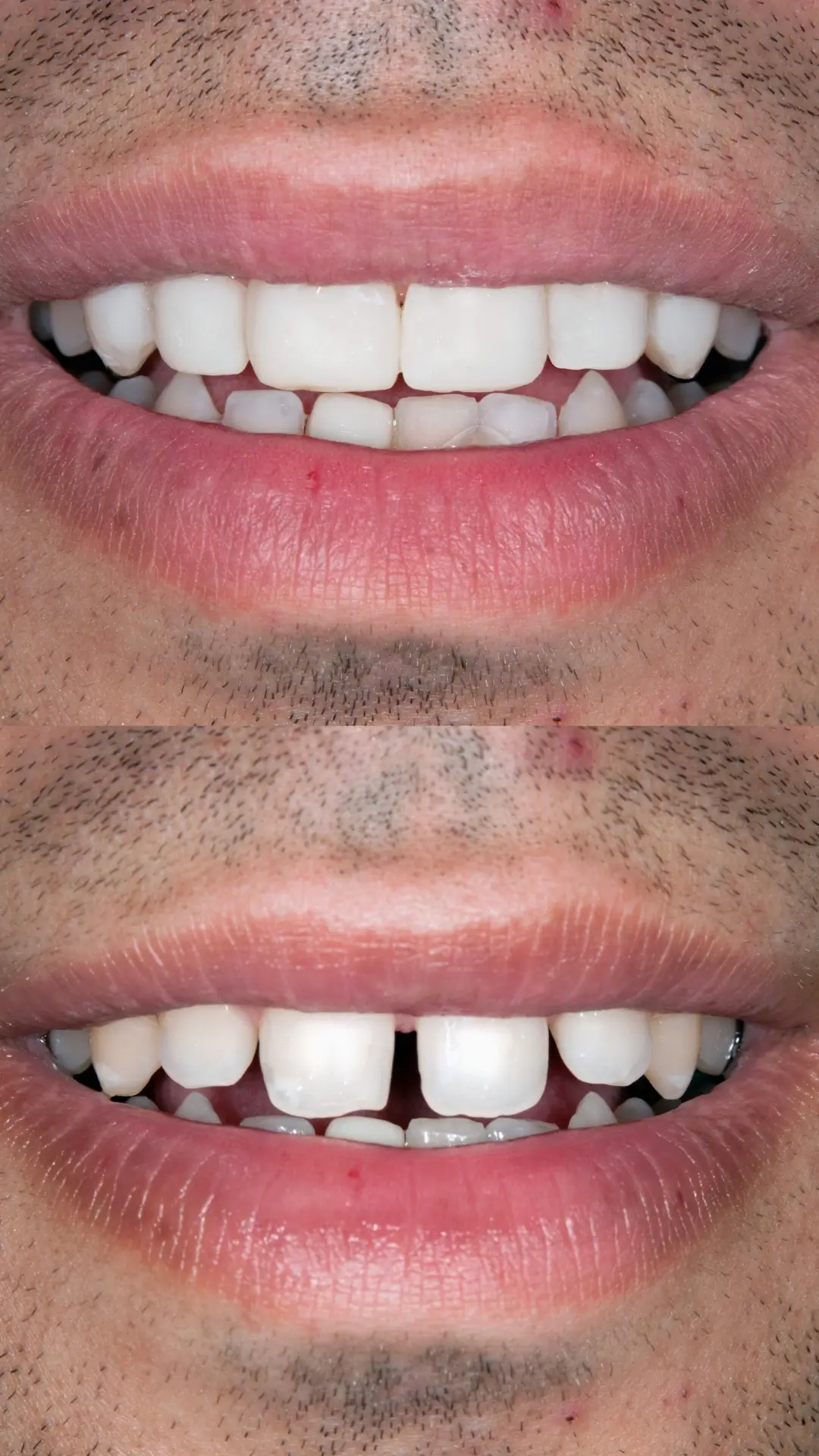 Diastema (Midline Gap) Closure - Before and After clinical results at Specialist Dental Clinic Guntur