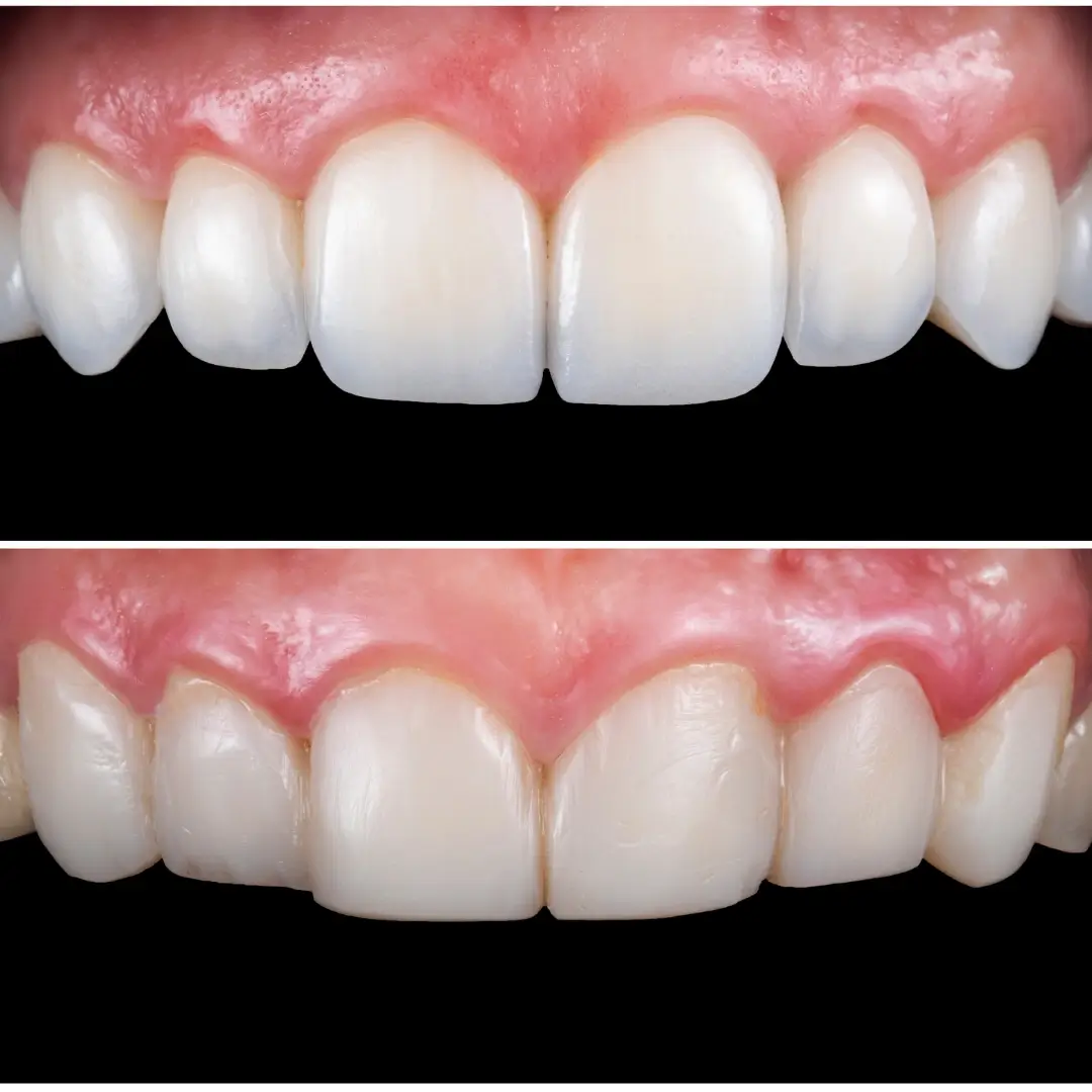 Gingival Contouring & Ceramic Veneers - Before and After clinical results at Specialist Dental Clinic Guntur