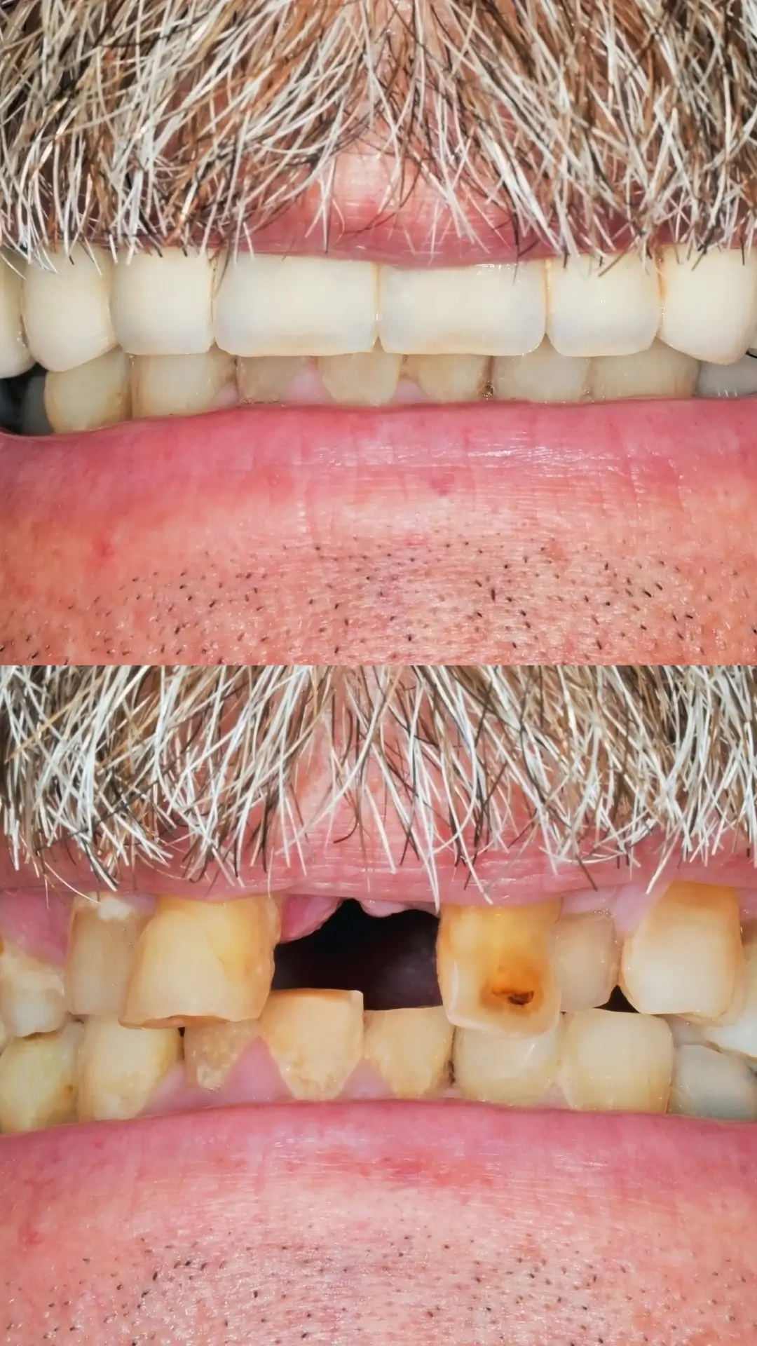 Missing Tooth Replacement & Implant Bridge - Before and After clinical results at Specialist Dental Clinic Guntur