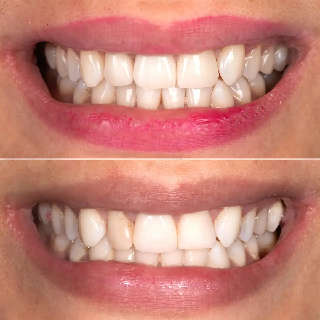 Ceramic Veneers & Smile Alignment - Before and After clinical results at Specialist Dental Clinic Guntur