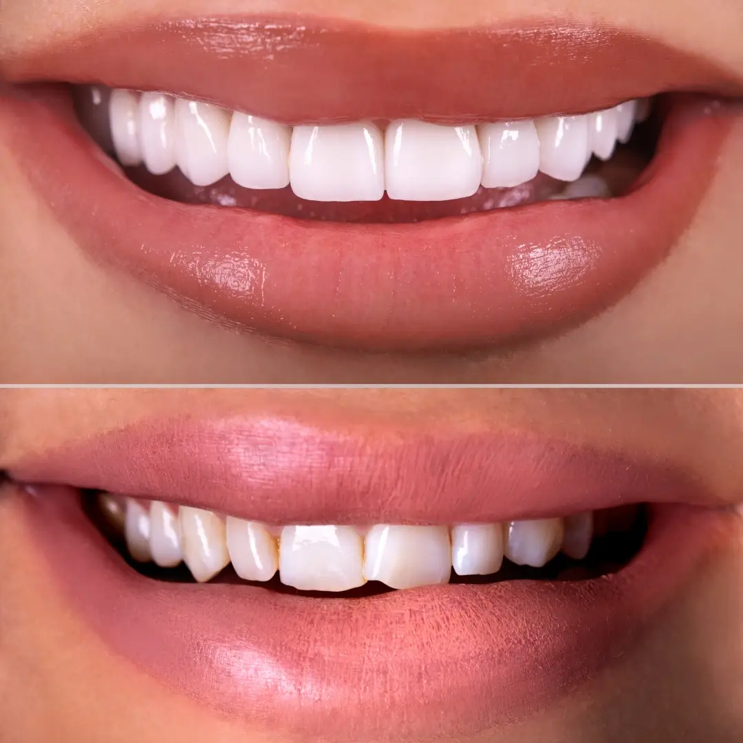 Ultra-Thin Porcelain Smile Design - Before and After clinical results at Specialist Dental Clinic Guntur