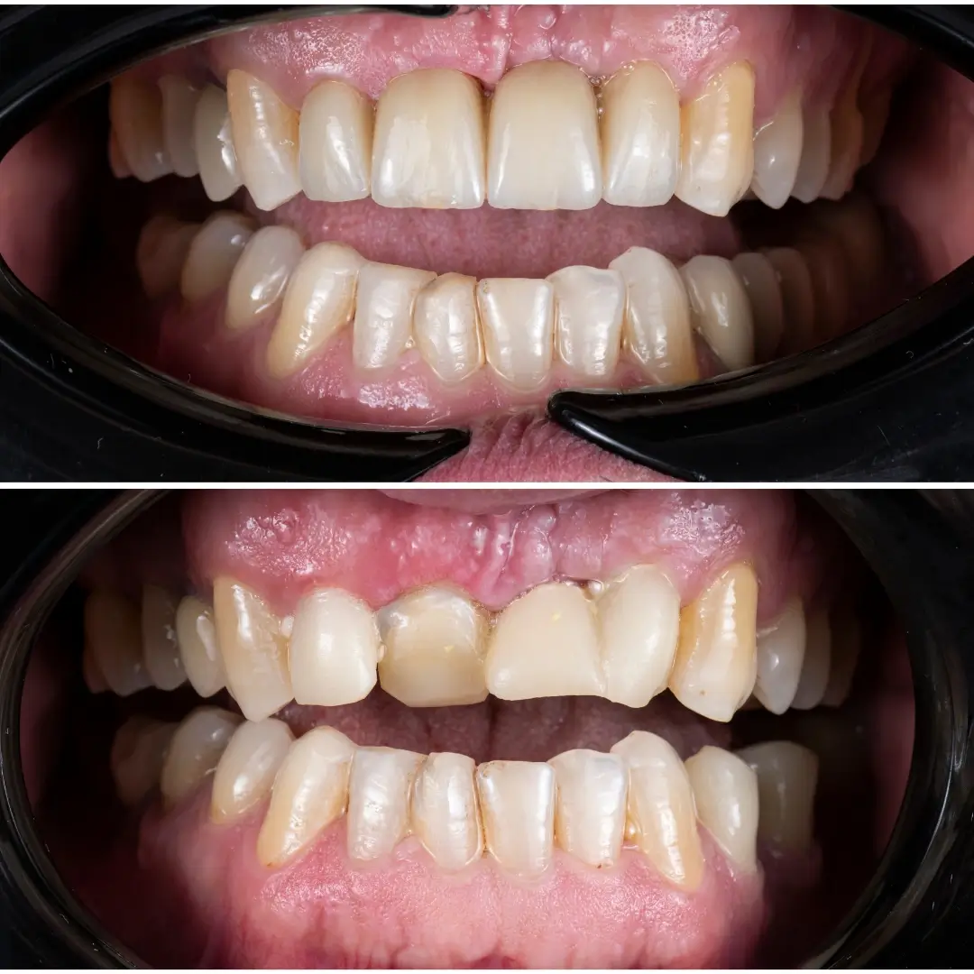 Fixed Prosthetic Realignment & Bite Restoration - Before and After clinical results at Specialist Dental Clinic Guntur