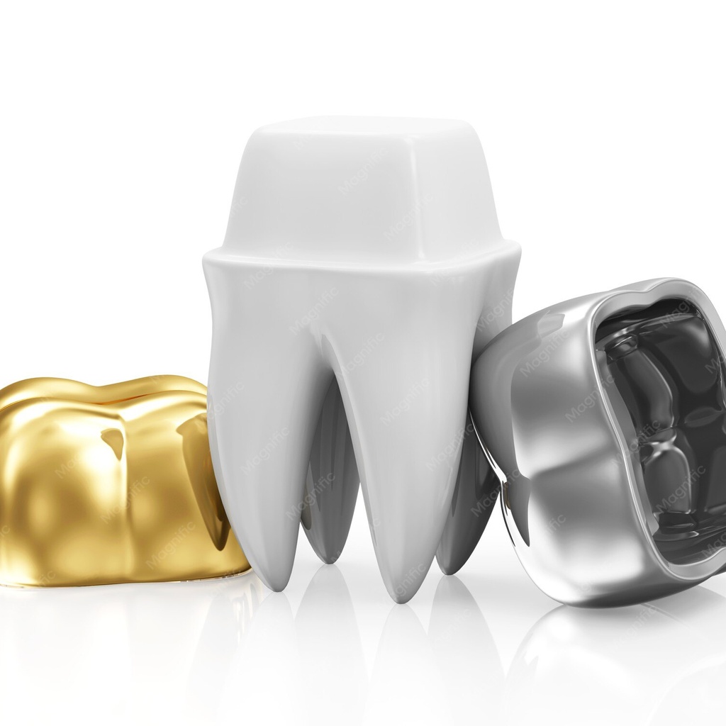 3D clinical illustration of CAD CAM PFM Crown