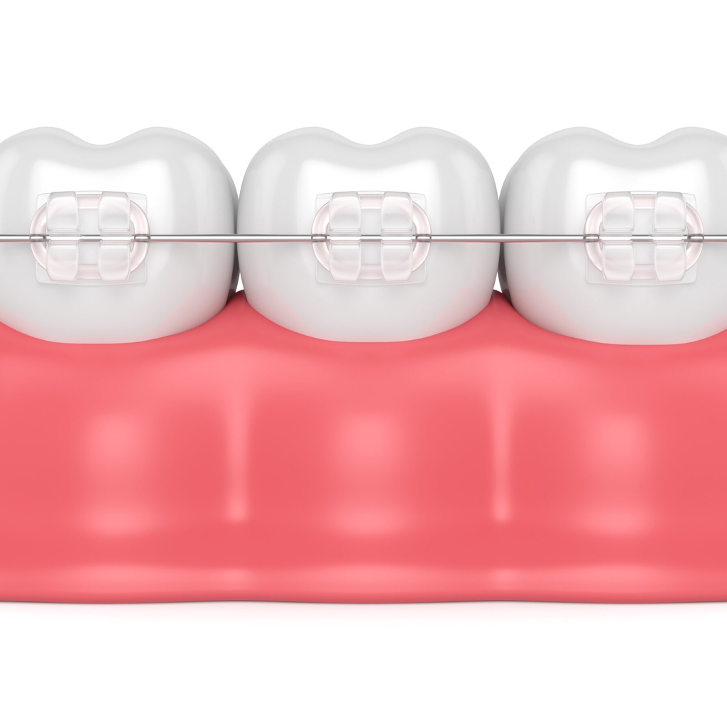 3D clinical illustration of Ceramic Braces