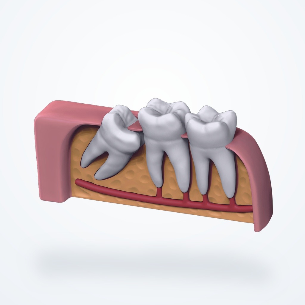 3D clinical illustration of Impaction of Tooth