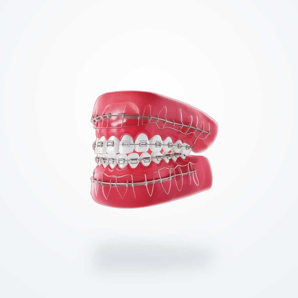 3D clinical illustration of Metal Braces