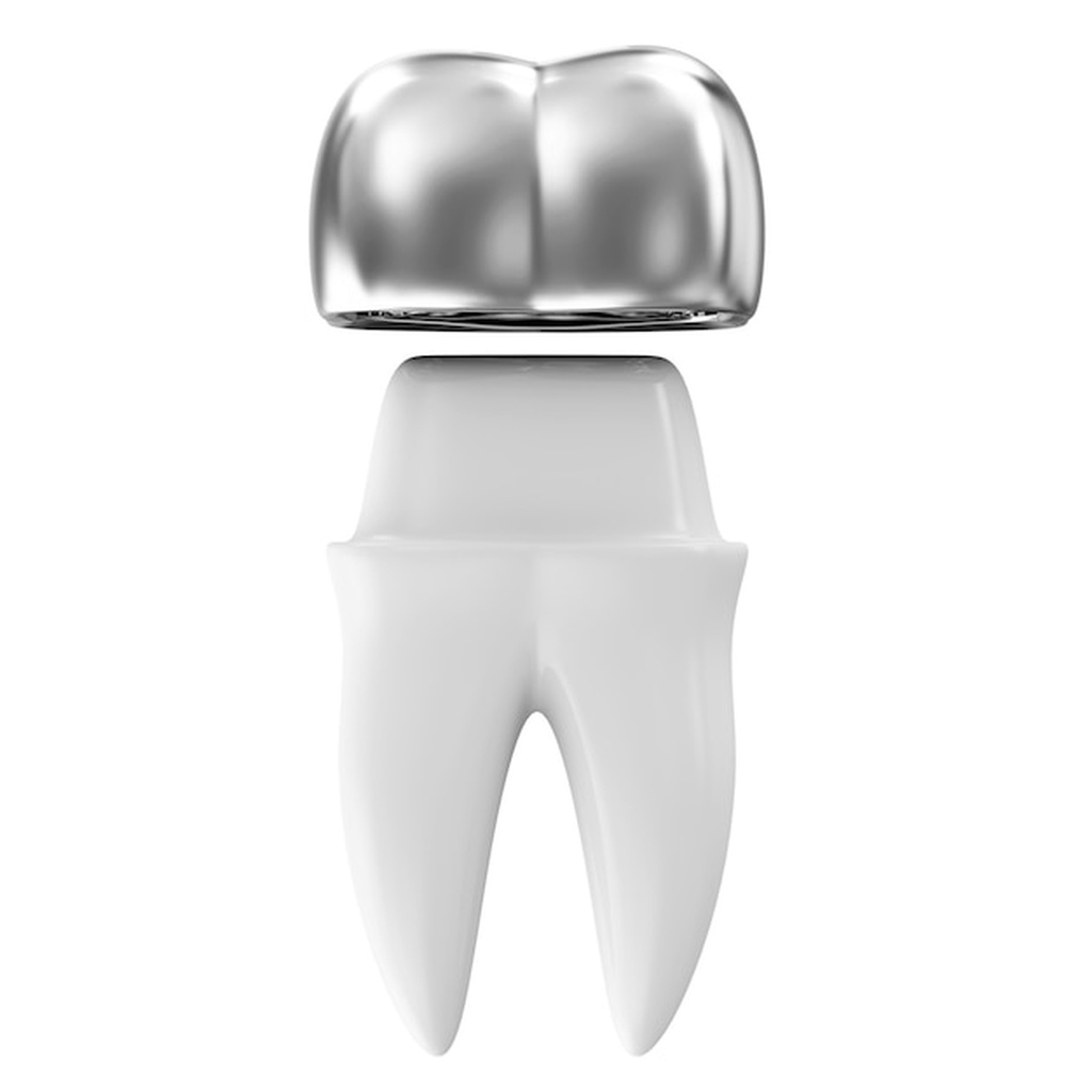 3D clinical illustration of Metal Ceramic Crown