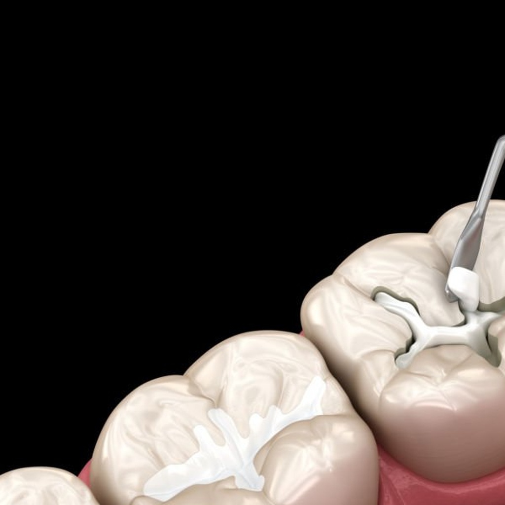3D clinical illustration of Tooth Restoration (Filling)